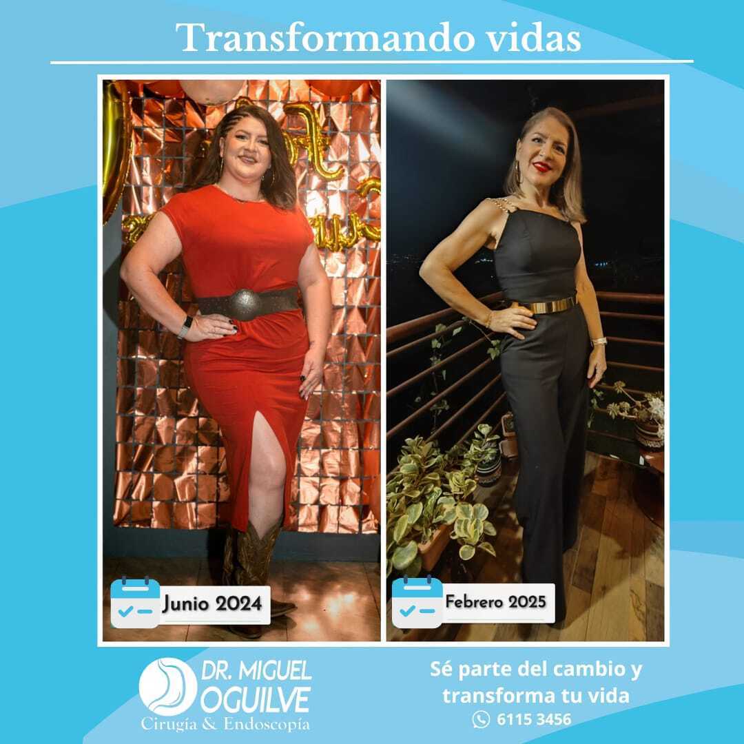 Resultado: Gastric Sleeve