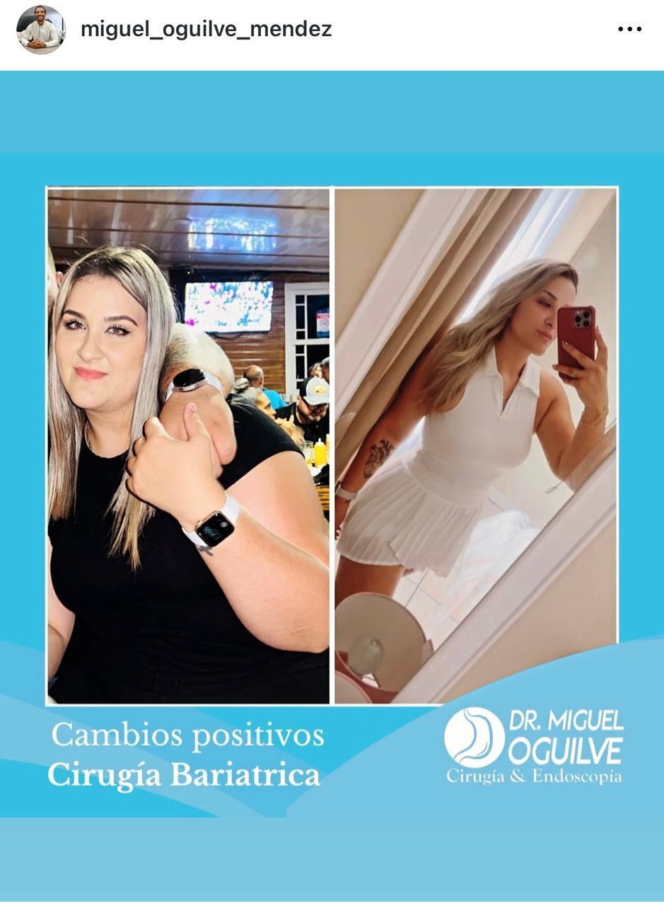 Resultado: Gastric Sleeve