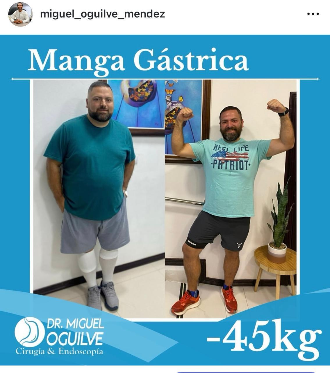Resultado real: Manga Gástrica -45kg